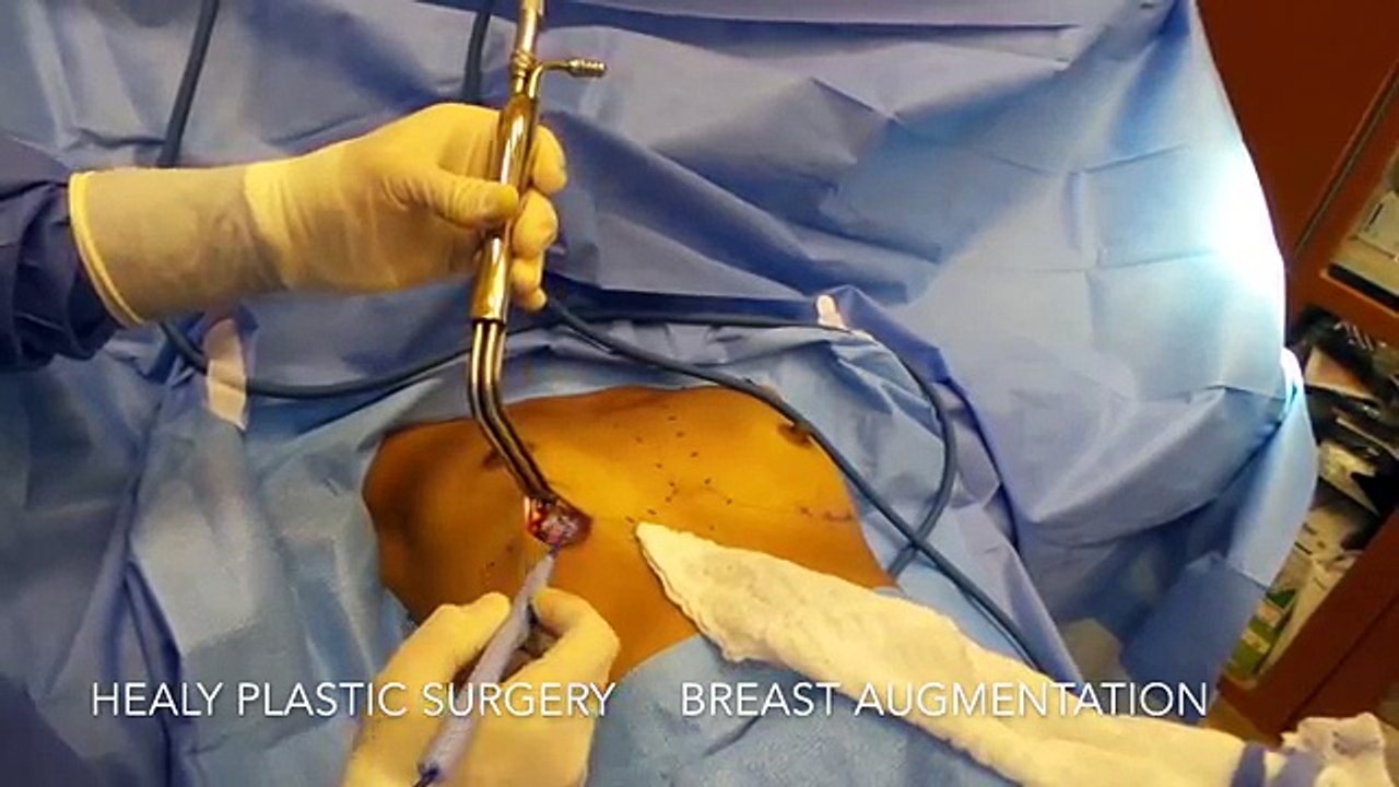 Breast Augmentation Honolulu Hawaii- Healy Plastic Surgery