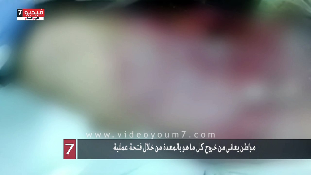 بالفيديو.. واقعة إهمال جديدة بمستشفى كفر الدوار.. مواطن يعانى من خروج كل ما هو بالمعدة من خلال فتحة عملية