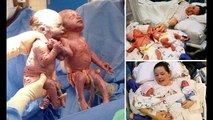 Meninas gêmeas nascem de mãos dadas em hospital norte americano