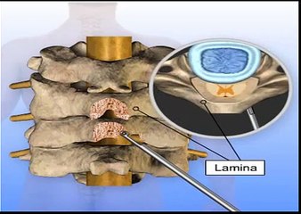 Posterior Cervical Laminectomy and Fusion Surgery Animation