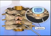 Posterior Cervical Laminectomy and Fusion Surgery Animation