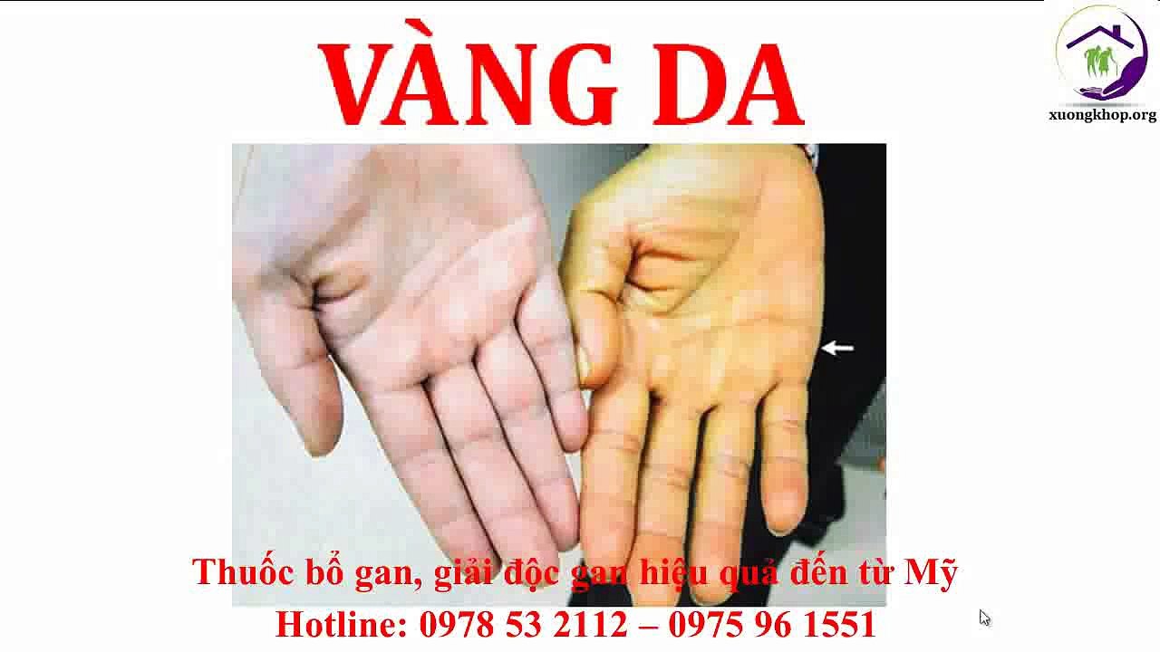 Dấu hiệu nhận biết bệnh xơ gan