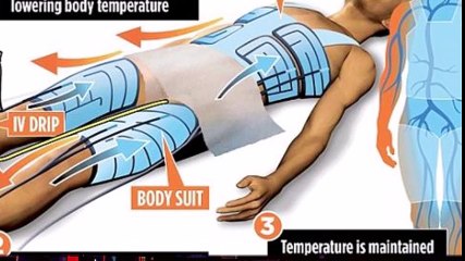 تصميم ” بدلة ذكية ” تساعد على إذابة الجلطة لدى مصابي السكتات الدماغية