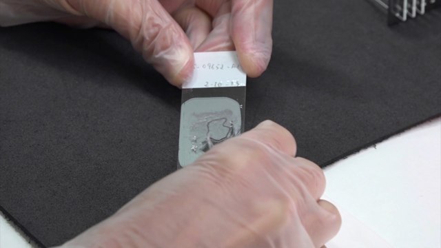 Primera inmunoterapia contra cáncer probada en personas