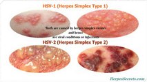 Causes, Signs and Symptoms of Herpes & The Cure