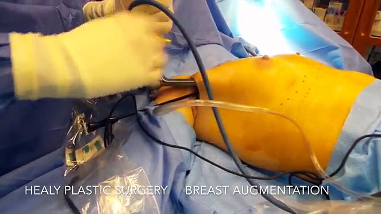Breast Augmentation- Trans-axillary Honolulu Hawaii- Healy Plastic Surgery