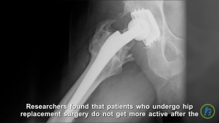 Increase in Exercise After Hip Replacement Surgery Not Common, Study finds