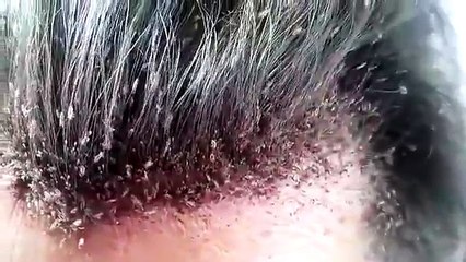 Cette femme héberge une veritable armée de poux dans ces cheveux