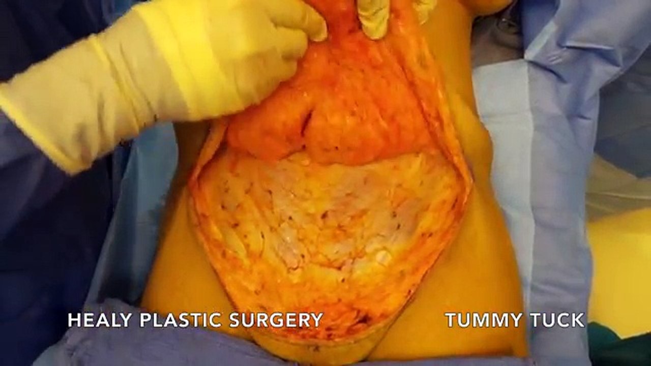 Tummy Tuck Honolulu Hawaii- Healy Plastic Surgery