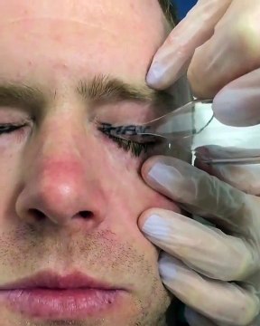 Un homme se fait détatouer les paupières après un very bad trip au Mexique