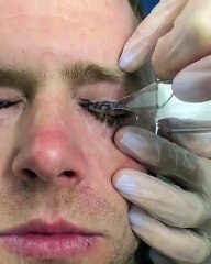 Douloureux, il se fait retirer son tatouage aux paupières