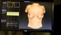 Breast Augmentation 3D Imaging with Vectra - Chicago Dr. Michael Horn