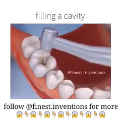 Filling a cavity