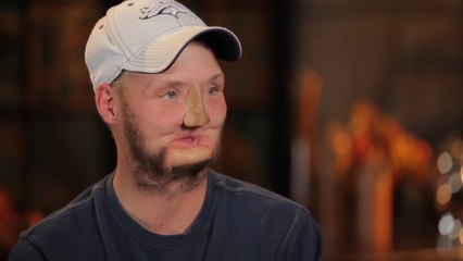 Man Receives ‘Miracle’ Face Transplant After Tragic Suicide Attempt