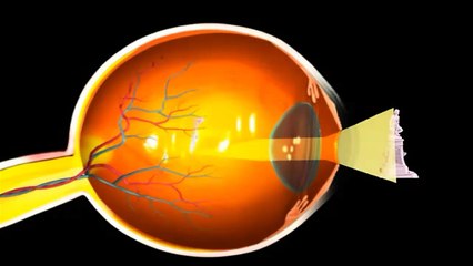 Accommodation disorder