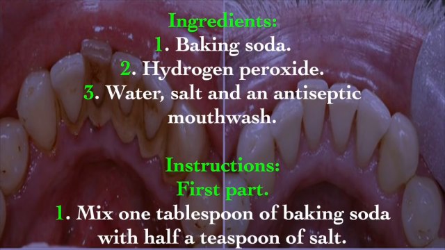 How to remove “PLAQUE” without going to the “DENTIST”. Awesome