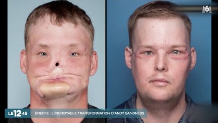 [Zap Actu] Une greffe de visage réussie aux États-Unis (28/02/17)