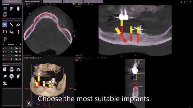 Computed tomography for dental implantation