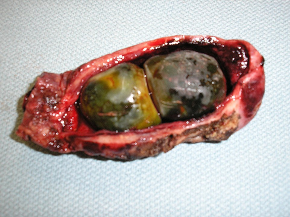 What Causes Liver and Gallbladder Problems?