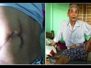 Quá nghèo cụ ông dùng dao rạch lưng tự lấy sỏi thận! [Chuyện lạ Việt Nam]