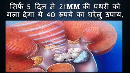 सिर्फ 5 दिन में 21mm की पथरी को गला देगा ये 40 रूपये का घरेलु उपाय