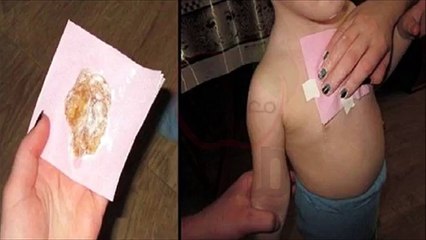 وصفة سحرية للتخلّص من السعال فوراً للكبار والاطفال