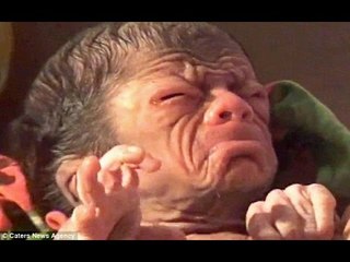 Nghẹn lời khi em bé vừa lọt lòng đã mang khuôn mặt của ông lão 80 tuổi.