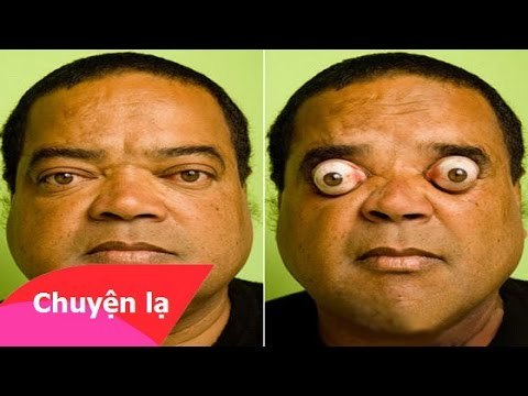 Chuyện lạ Việt Nam – Người đàn ông có đôi mắt lồi ra ngoài đến khó tin