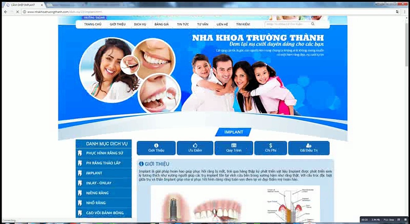 Implant - Nha Khoa Trường Thành