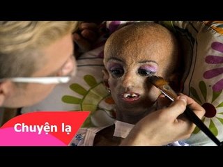 Chuyện lạ có thật - Bé gái 15 tuổi hóa thành Bà lão 90