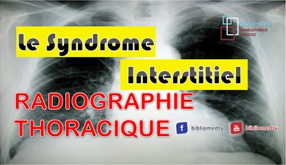 Radiographie du Thorax - Syndrome Interstitiel