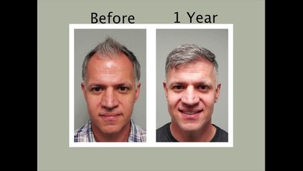 Hair Transplant 1 Year Followup - Hair Transplant Before and After (Roger)