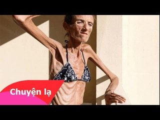 Chuyện lạ Việt Nam - Những người gầy nhất thế giới