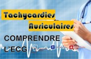 ECG - Les Tachycardies Auriculaires