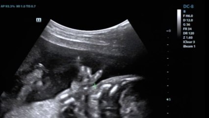 Ce bébé fait le signe Rock de la main dans le ventre de sa mère ! Echographie