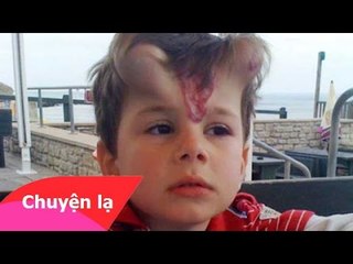 Chuyện lạ Việt Nam – Cậu bé mọc sừng quỷ trên trán