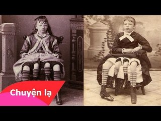 Chuyện lạ Việt Nam – Người phụ nữ bốn chân