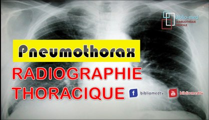 Radiographie du Thorax - Pneumothorax