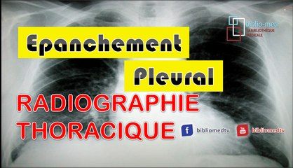 Radiographie du Thorax - Epanchement Pleural