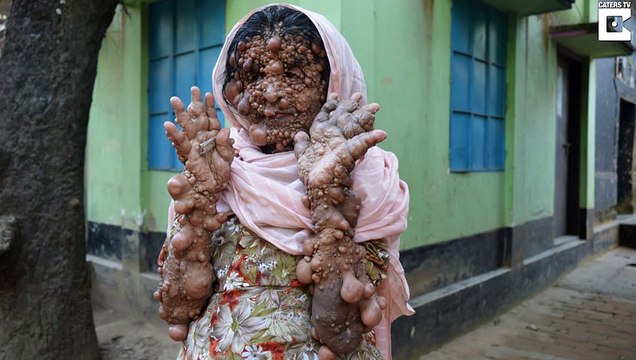 Woman's Entire Body Covered With Tumours