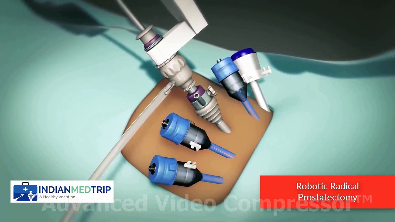 Robotic Prostatectomy - Best Treatment for Prostate Cancer