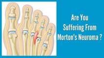 Modpod Sports Podiatry For Morton's Neuroma Treatment