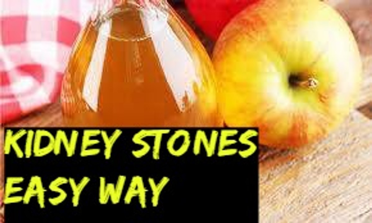 گُردے کی پتھری کو ختم کرے کا آسان اور گارنٹی شُدہ علاج