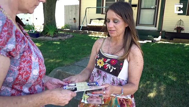 Woman Has 6,000 Tumours Covering Her Body