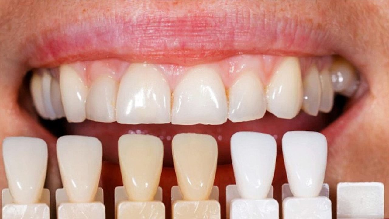 Invisalign Braces Maryland Heights Mo