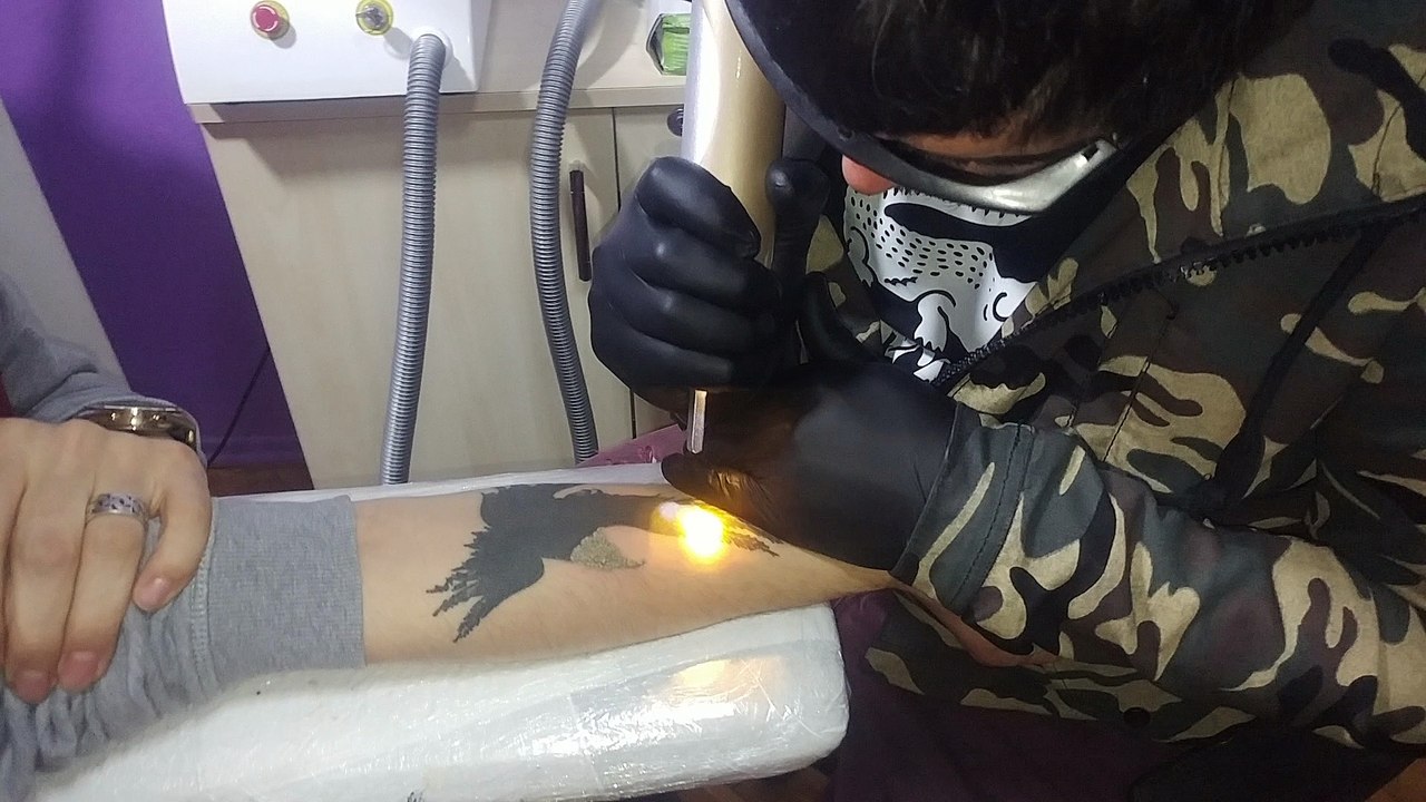Düzce Karasu Dövme Silme Nd Yag