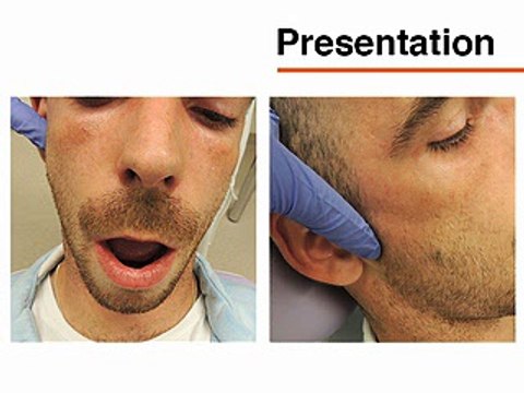 Repositioning Dislocated Temporomandibular Joints