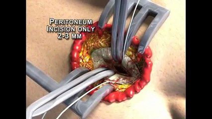 Diagnostic Peritoneal Lavage