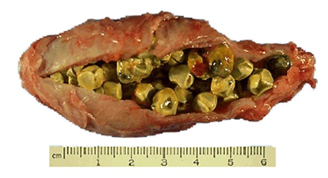 How To Flush Out Gallstones : Gallbladder And Gallstones