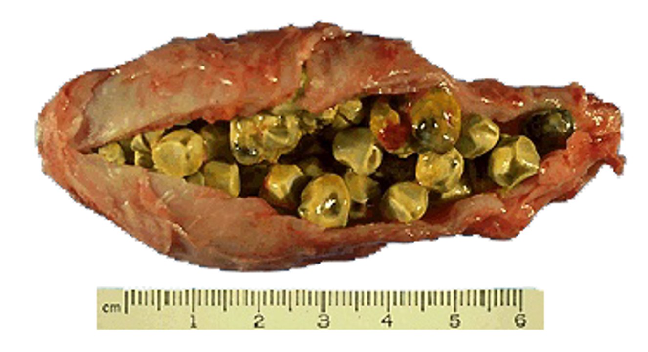 How To Flush Out Gallstones : Gallbladder And Gallstones